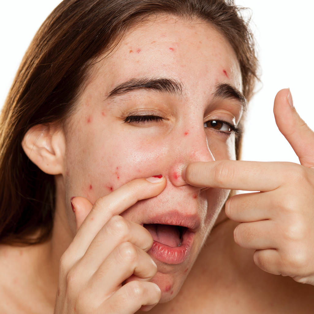 Wat veroorzaakt je acne? En nog belangrijker: wat kun je eraan doen?